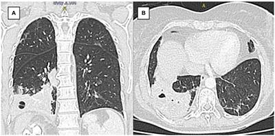 Fatal nephrobronchial fistula arising from xanthogranulomatous pyelonephritis: a case report